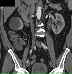 Tumor of Proximal Left Ureter- Transitional Cell Cancer (TCC) - CTisus CT Scan