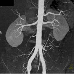 Normal Renal Arteries - CTisus CT Scan
