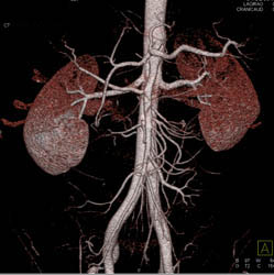 Normal Renal Arteries - CTisus CT Scan