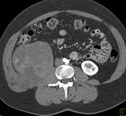 Leiomyosarcoma - CTisus CT Scan