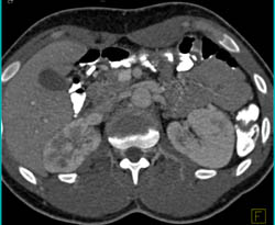 Acute Pyelonephritis - CTisus CT Scan