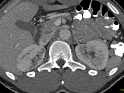 Acute Pyelonephritis - CTisus CT Scan