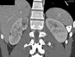 Acute Pyelonephritis - CTisus CT Scan