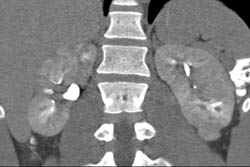 Acute Pyelonephritis - CTisus CT Scan