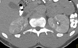 Acute Pyelonephritis - CTisus CT Scan