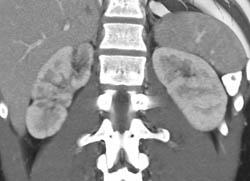 Acute Pyelonephritis - CTisus CT Scan