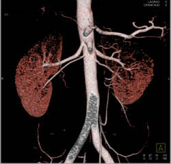 3D Rendering in VRT and MIP of Multiple Renal Arteries - CTisus CT Scan