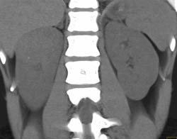 Clear Cell Renal Cell Carcinoma (RCC) in A 17 Year Old Female in Multiple Phases - CTisus CT Scan