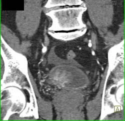 Bladder Cancer - CTisus CT Scan