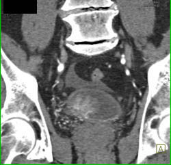 Bladder Cancer - CTisus CT Scan