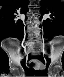 Bladder Cancer - CTisus CT Scan