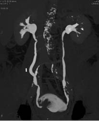 Bladder Cancer - CTisus CT Scan