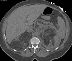 Multiple Angiomyolipomas (AMLs) With Prior Embolization - CTisus CT Scan