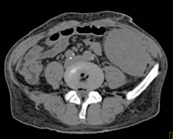 Acute Pyelonephritis in A Renal Transplant Patient - CTisus CT Scan