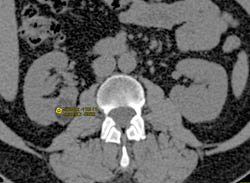 Renal Angiomyolipoma (AML) - CTisus CT Scan