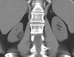 Renal Angiomyolipoma (AML) - CTisus CT Scan