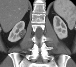 Renal Angiomyolipoma (AML) - CTisus CT Scan