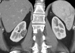 Renal Angiomyolipoma (AML) - CTisus CT Scan