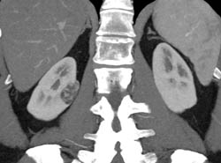 Renal Angiomyolipoma (AML) - CTisus CT Scan