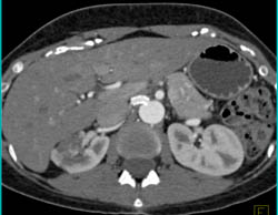 Renal Infarct - CTisus CT Scan