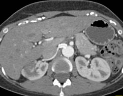 Renal Infarct - CTisus CT Scan