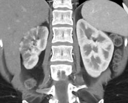 Renal Infarct - CTisus CT Scan