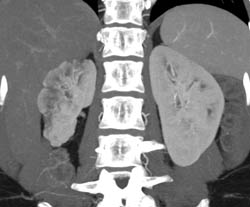 Renal Infarct - CTisus CT Scan