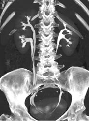 Duplicated Collecting System on CT Urogram - CTisus CT Scan