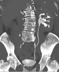 Ct Urogram S/P Nephrectomy - CTisus CT Scan