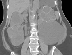 Polycystic Kidney Disease With Indeterminate Lesions - CTisus CT Scan