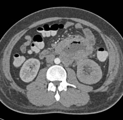 Spindle Cell Carcinoma of Small Bowel Involves Left Kidney - CTisus CT Scan