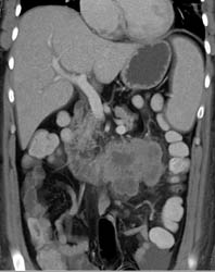 Spindle Cell Sarcoma Metastatic to Small Bowel and Involves Kidney Secondarily - CTisus CT Scan