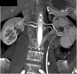 Double Renal Arteries and Retroaortic Vein - CTisus CT Scan