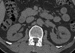 Multiple Phase Imaging With Left Renal Cell Carcinoma - CTisus CT Scan