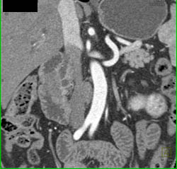 Metastatic Renal Cell Carcinoma to the Duodenum - CTisus CT Scan