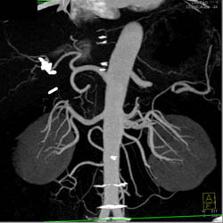 Normal Renal Arteries - CTisus CT Scan