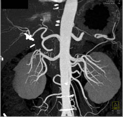 Normal Renal Arteries - CTisus CT Scan