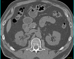 Acute Pyelonephritis - CTisus CT Scan