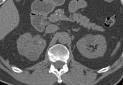 Acute Pyelonephritis - CTisus CT Scan