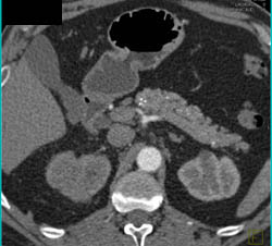 Acute Pyelonephritis - CTisus CT Scan