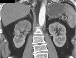 Acute Pyelonephritis - CTisus CT Scan