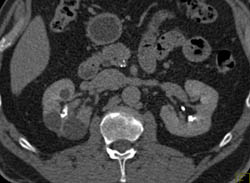 Acute Pyelonephritis - CTisus CT Scan