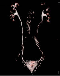 Acute Pyelonephritis - CTisus CT Scan