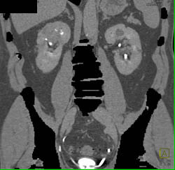 Acute Pyelonephritis - CTisus CT Scan