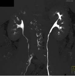 Acute Pyelonephritis - CTisus CT Scan