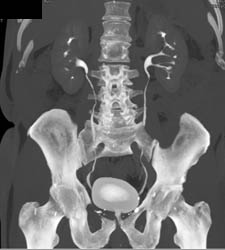 Acute Pyelonephritis - CTisus CT Scan