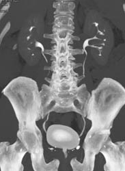 Acute Pyelonephritis - CTisus CT Scan