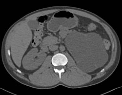 Dysplastic Left Kidney - CTisus CT Scan