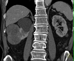 Renal Cell Carcinoma - CTisus CT Scan