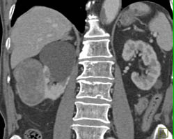 Renal Cell Carcinoma - CTisus CT Scan